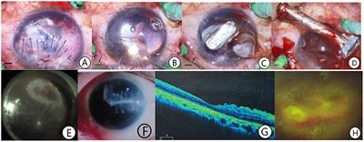 Exploring Minimum Secondary Injury for the Treatment of Ocular Trauma With Giant Intraocular Foreign Bodies